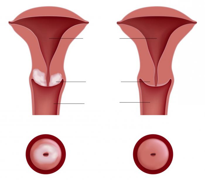 Радиоволновый método de tratamento de erosão do colo do útero