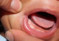 溃疡在牙龈的儿童：原因和治疗