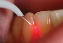 Від чого з'являється зубний камінь? Причини утворення каменю