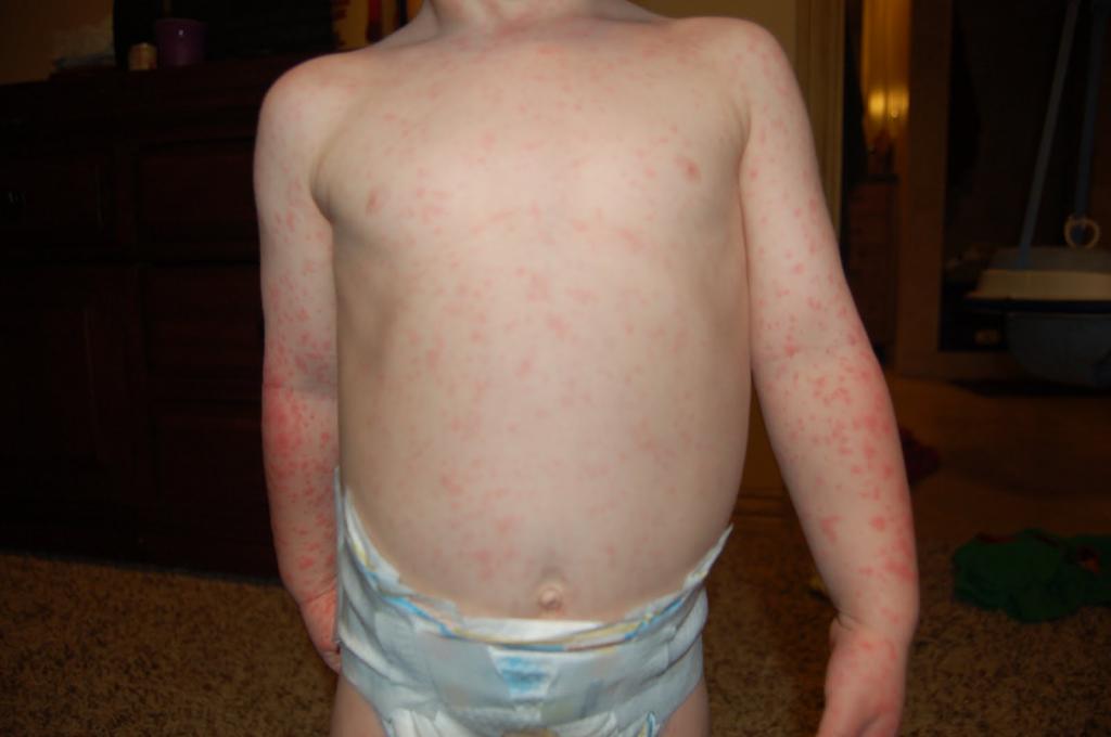 Signs of scarlet fever in children photos the initial stage