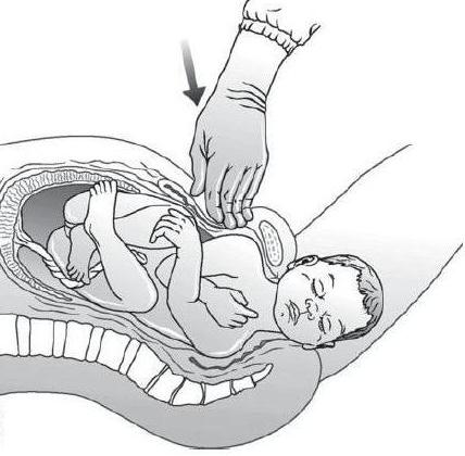 лонное зчленування при вагітності