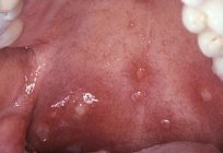 如何治疗疱疹的喉咙在孩子吗？