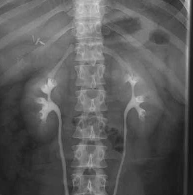 um raio x dos rins com contraste
