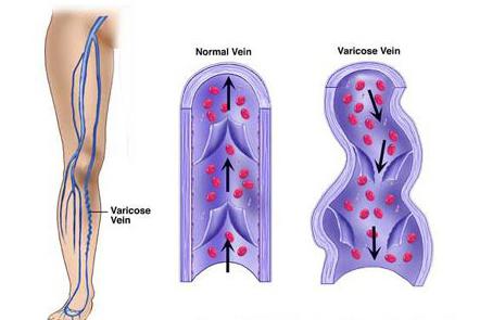 крем від варикозу varicose veins спосіб застосування