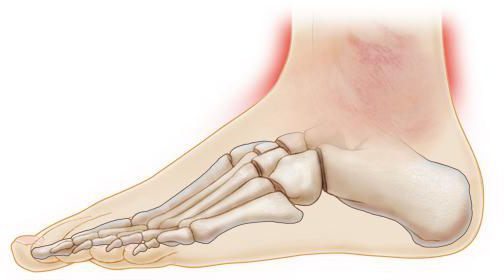 la articulación del tobillo se hincha y duele como curar los síntomas de la