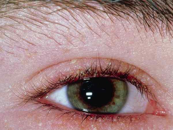 الكلورامفينيكول العين تعليمات الاستخدام
