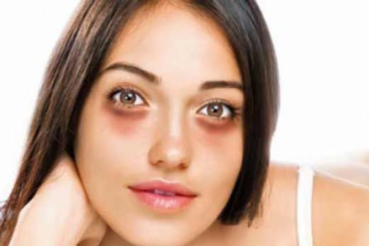 bags and dark circles under the eyes how to remove