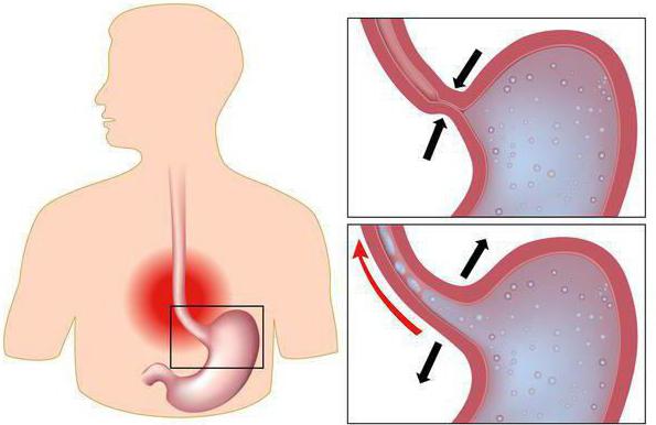 heartburn and belching causes and cures
