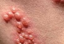 Herpes in a child: treatment with folk remedies is not only