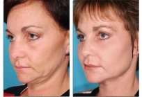 Laser Resurfacing Gesichtsbehandlung: Indikationen und Kontraindikationen, Pflege nach dem Eingriff, die vor-und Nachteile, Bewertungen