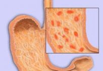 A gastrite crônica. Tratamento e causas
