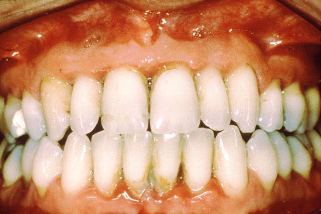 Zahnfleischentzündung bei Kindern