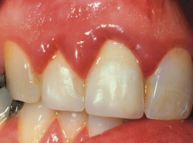 behandeln als Zahnfleischentzündung