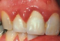 Entzündet das Zahnfleisch, was tun? Fragen Sie den Zahnarzt