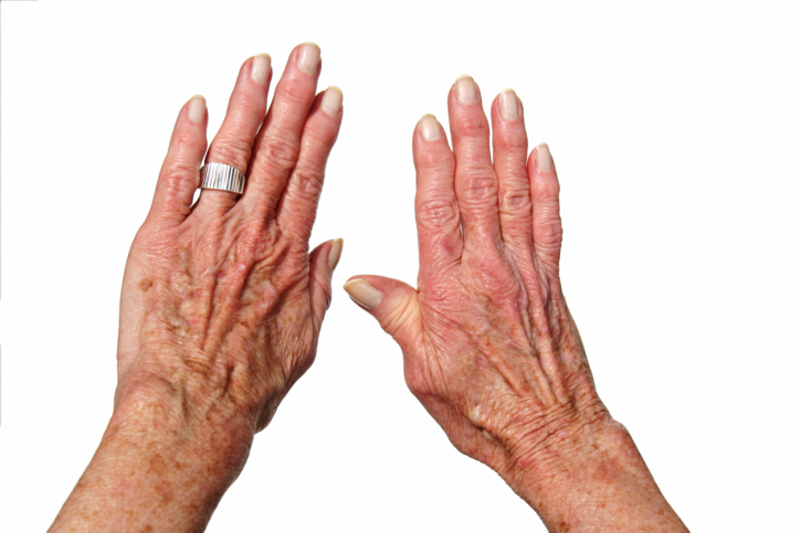 sinais de artrite reumatóide