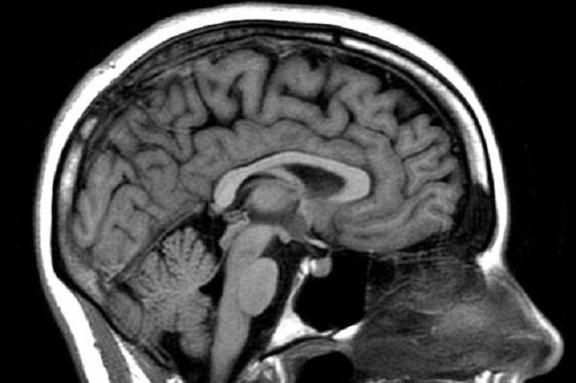 الأشعة المقطعية أو التصوير بالرنين المغناطيسي الذي هو أفضل للدماغ