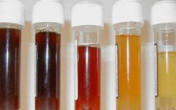 the dark color of urine during pregnancy