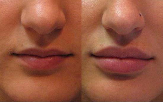 Botulinumtoxin in der Kosmetik Foto vor und nach der