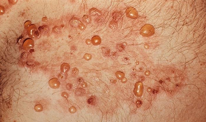 herpetiformis皮膚炎の写真