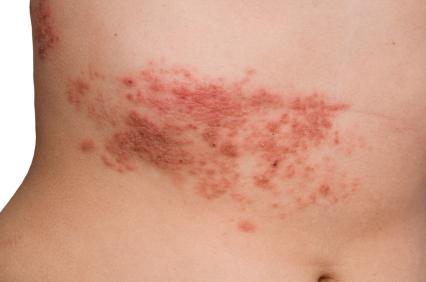 герпетиформный los síntomas de la dermatitis