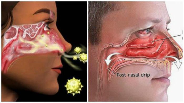 клінічная анатомія носа насавая паражніну