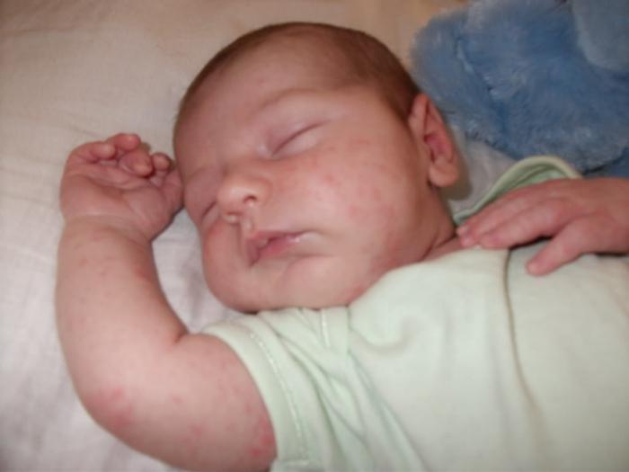 ما هو مرض التعرق في الأطفال حديثي الولادة