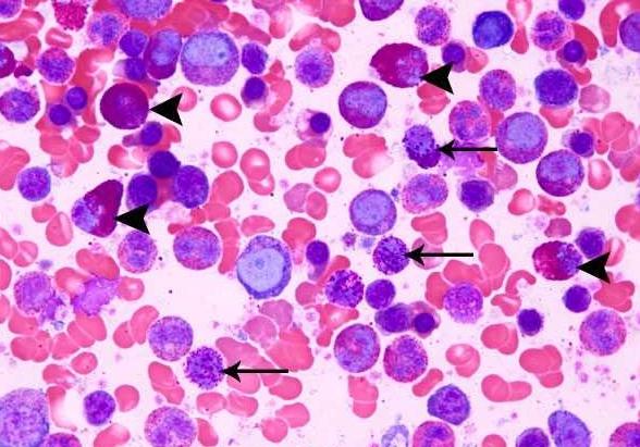 嗜曙红细胞在血液中增加