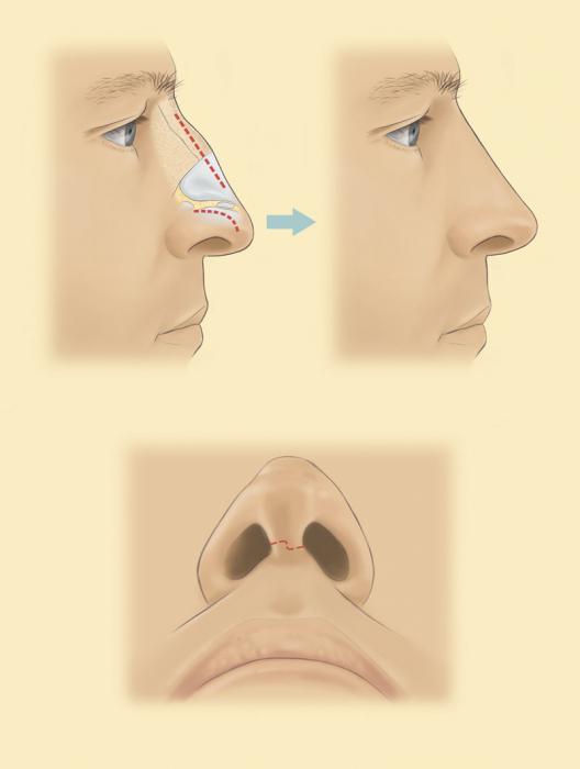 korekcja czubka nosa