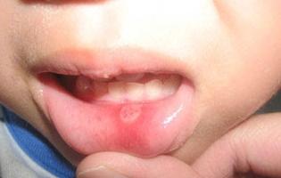الفم في الأطفال يسبب