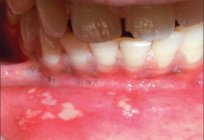 أعراض التهاب الفم في الأطفال. الأسباب والعلاج والوقاية