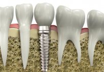 Problemas dentários: causas e recomendações do médico