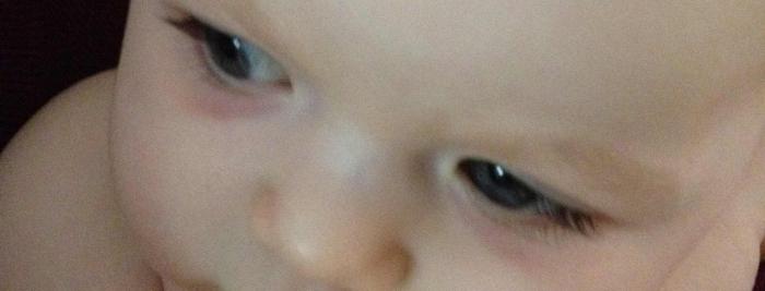 Das Baby hat blaue Flecken unter den Augen