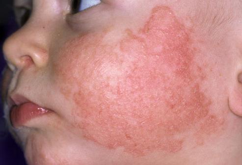 rash on the face of children