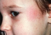 Rash on the face of children: causes of appearance