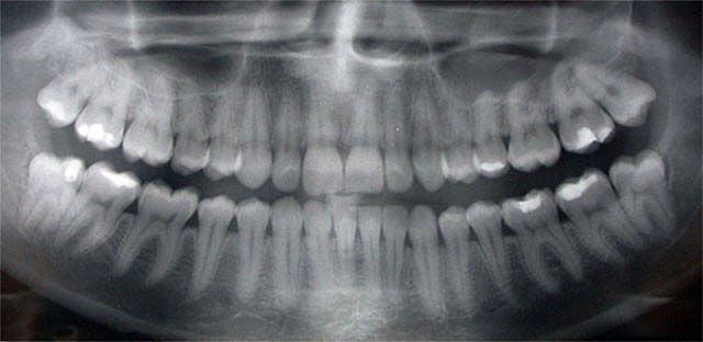 x-ray Bild der Zähne