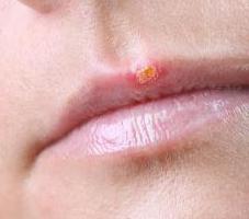 herpes resfriado comum nos lábios tratamento