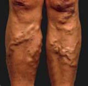 血栓性静脉炎的下肢的照片