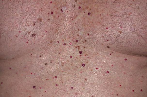 there are red moles on the body