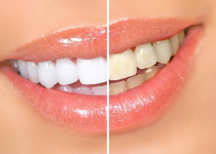 नुस्खा के लिए दांत whitening हाइड्रोजन पेरोक्साइड