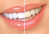 An unusual way to use hydrogen peroxide: teeth whitening