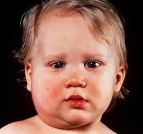 vaccination on mumps