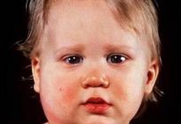 Mumps: symptoms and treatment