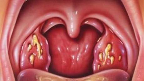 cancer of the tonsil photo