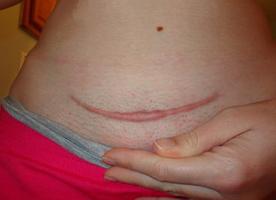parto após uma cesárea