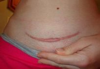 Kaiserschnitt: die Wiederherstellung nach ihm und Prognose der späteren Geburt