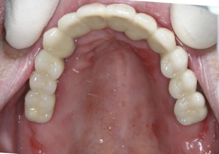 दंत कृत्रिम अंग ACRI फ्राइज़