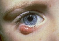 الشعير على العين. الأعراض والعلاج