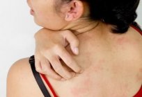 The symptoms of atopic dermatitis. Causal factors and treatment