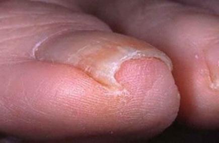 połżna paznokci leczenie w warunkach domowych