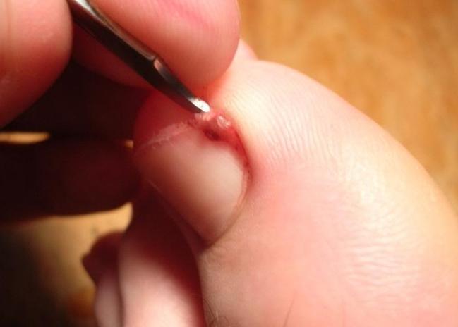 remove ingrown nail